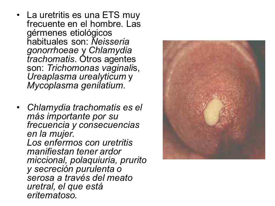 uretritis de la mujer